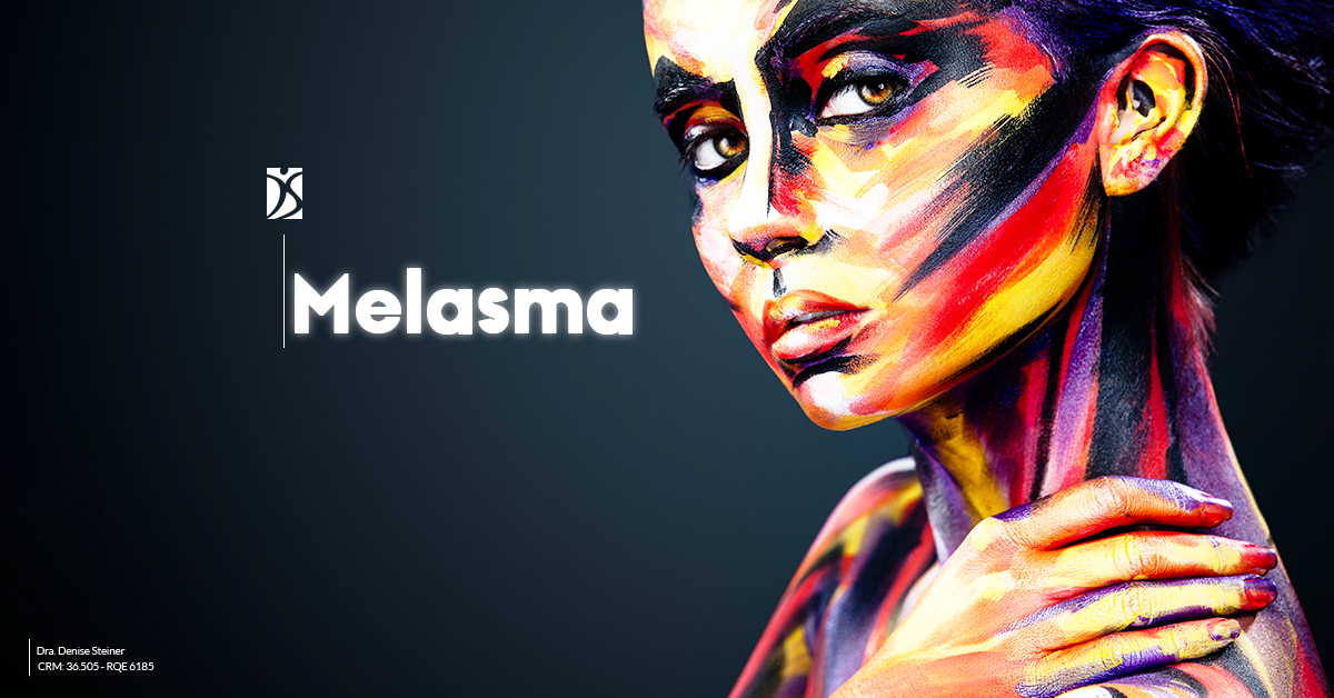 melasma