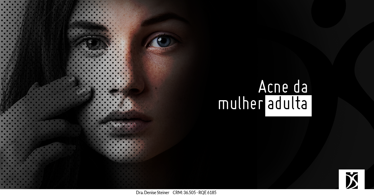 acne da mulher adulta