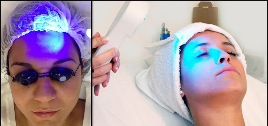 Tratamento da acne com luz e laser