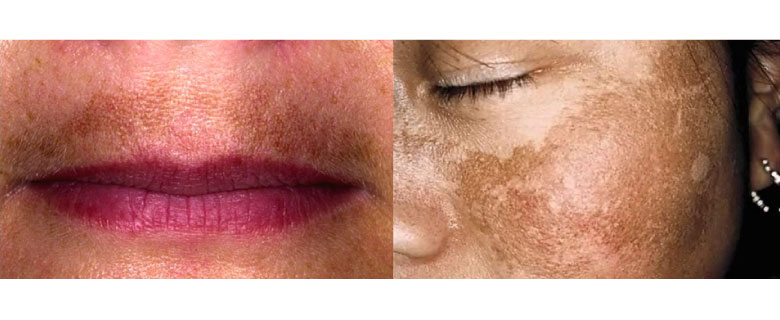 Tratamento Melasma