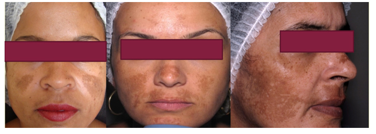 melasma