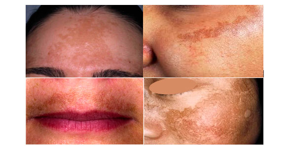 melasma