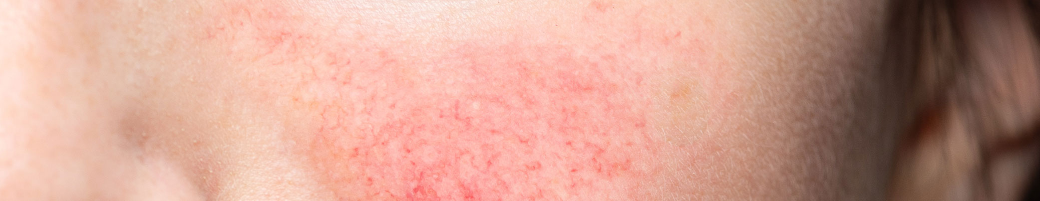 rosacea