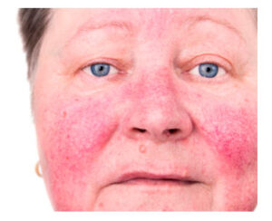 rosacea