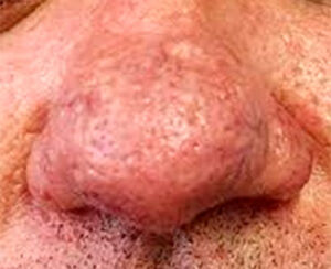 rosacea