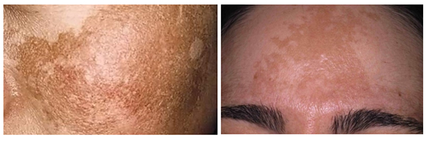 melasma