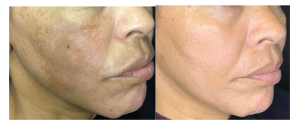 melasma