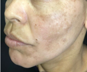 melasma-e-muito-mais-que-uma-mancha