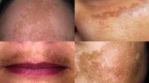 remedio-para-diabete-e-utilizado-para-tratar-melasma