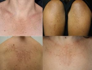 remedio-para-tratar-diabete-e-usado-para-tratar-melasma