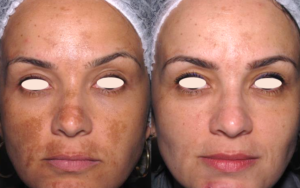 remedio-para-tratar-diabete-e-usado-para-tratar-melasma