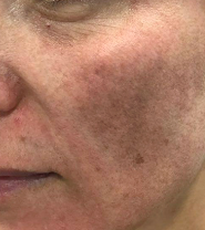 a-pele-manchada-do-melasma-tambem-e-flacida