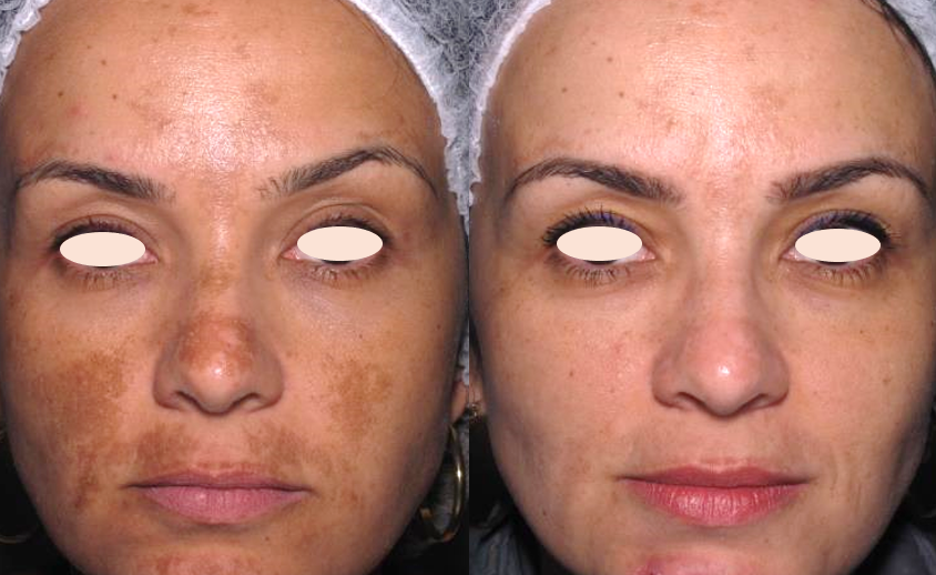 a-pele-manchada-do-melasma-tambem-e-flacida